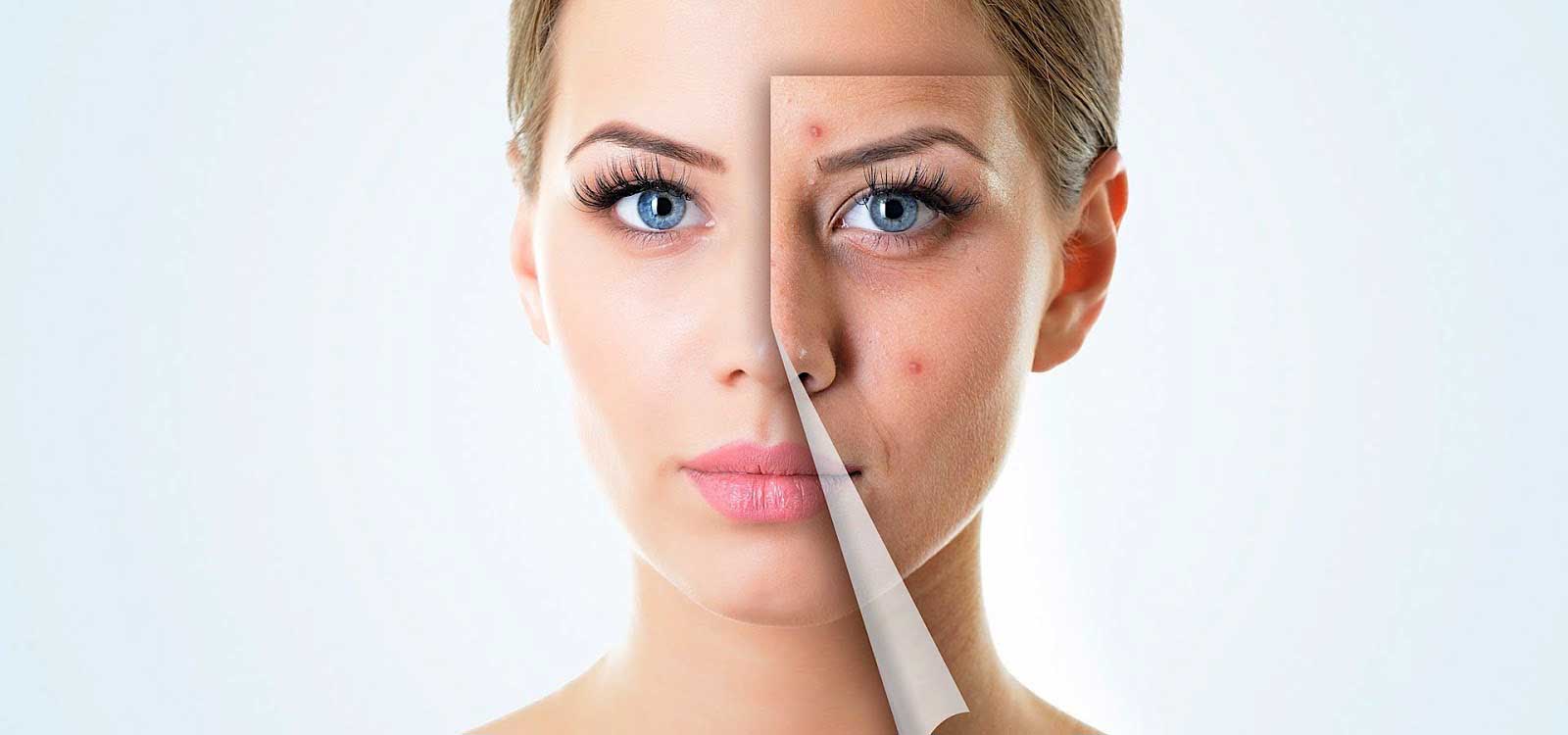 Optimal diet to get rid of acne