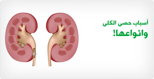 Causes of kidney stones and their types